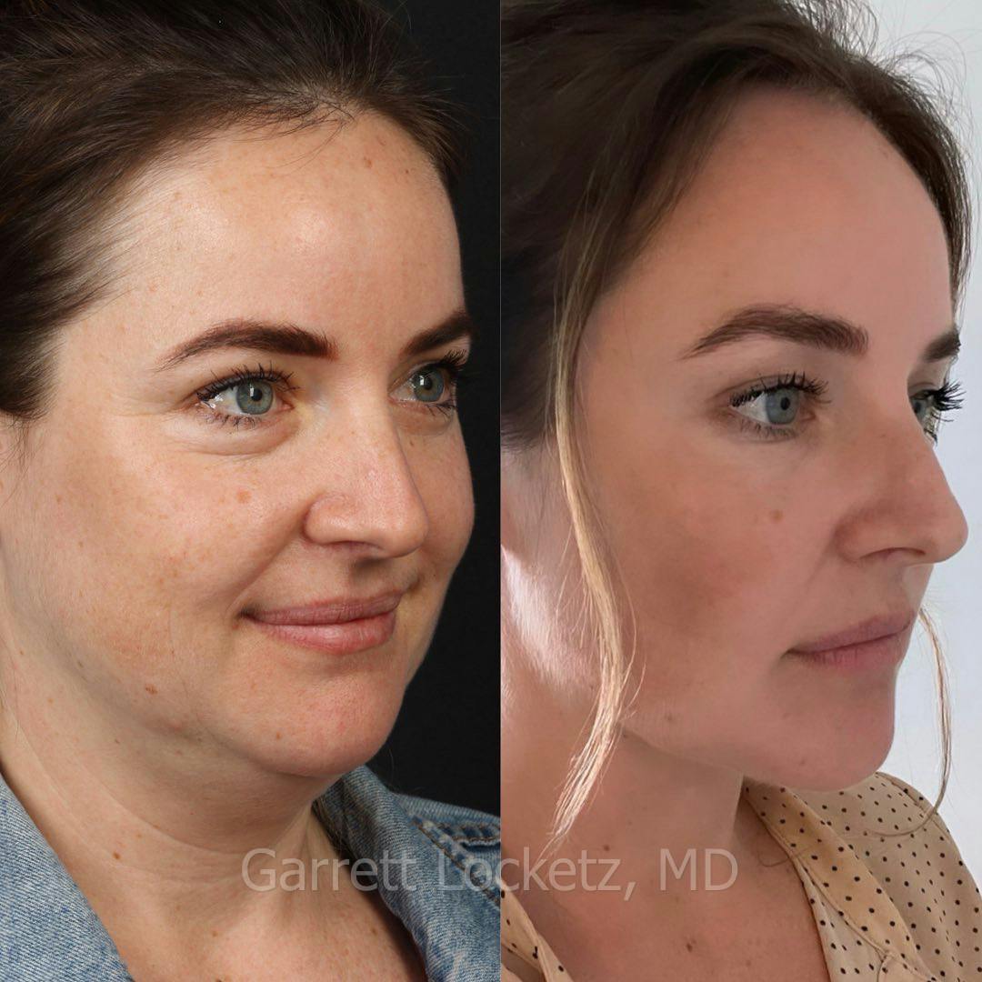 Deep Neck Lift Before & After Gallery - Patient 196509887 - Image 1