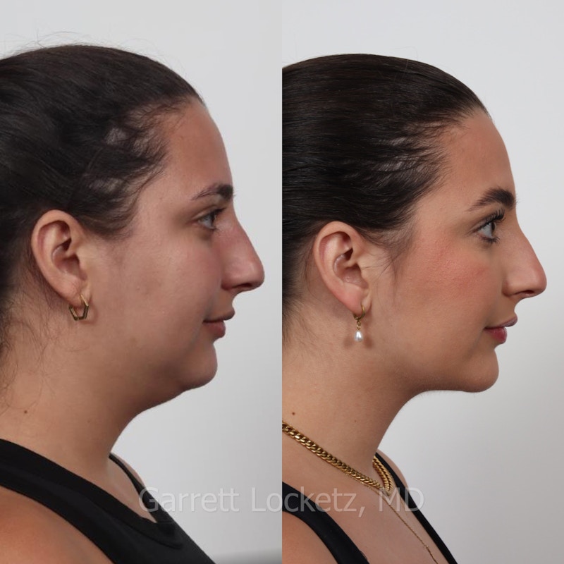 Deep Neck Lift Before & After Gallery - Patient 196509888 - Image 1