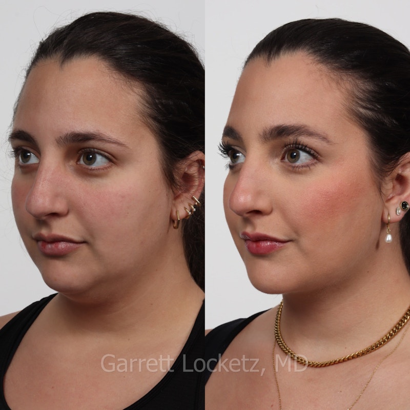 Deep Neck Lift Before & After Gallery - Patient 196509891 - Image 1