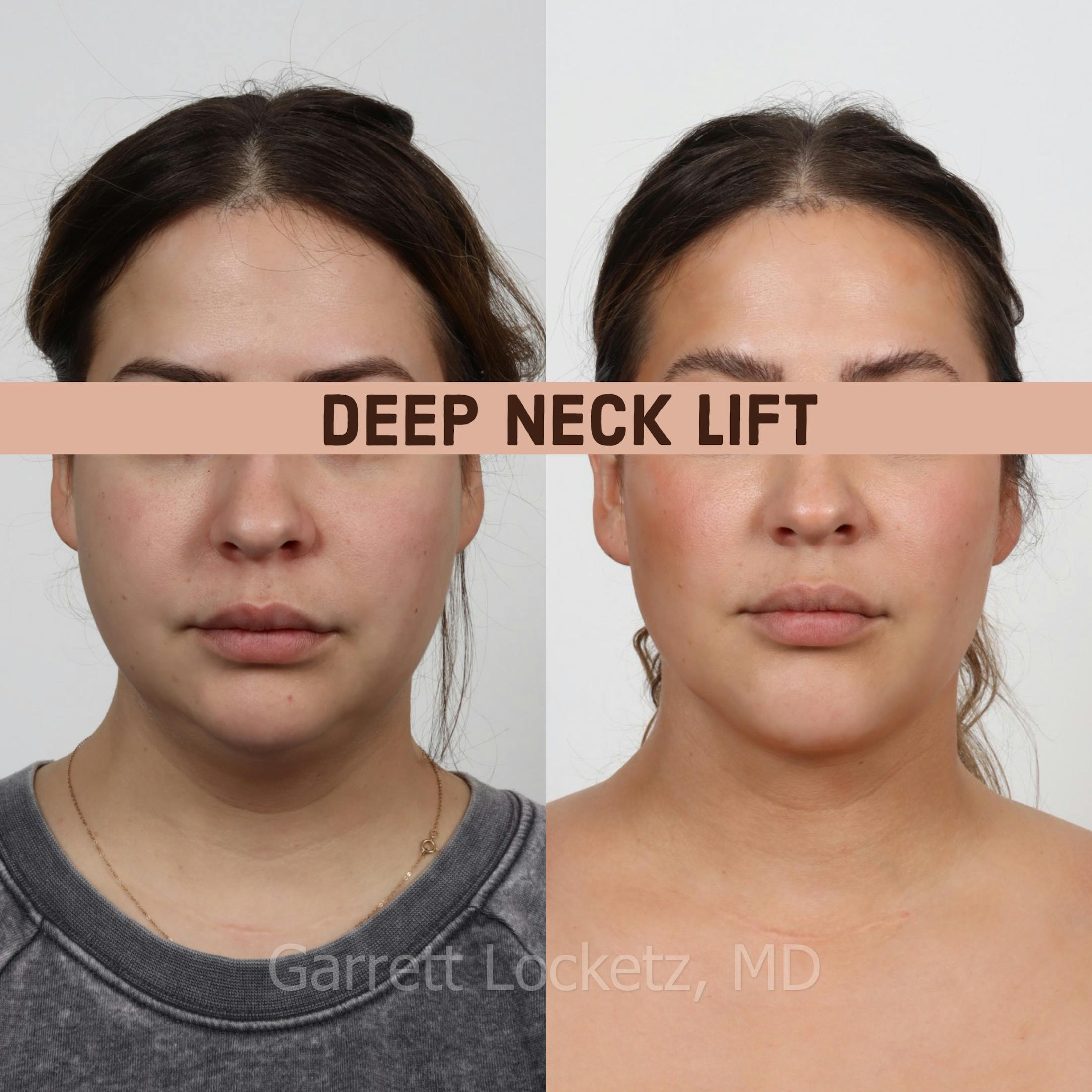Deep Neck Lift Before & After Gallery - Patient 196509892 - Image 1