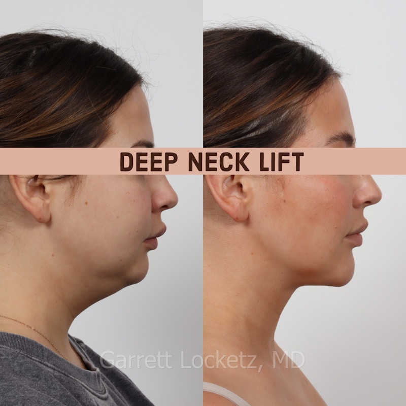 Deep Neck Lift Before & After Gallery - Patient 196509893 - Image 1