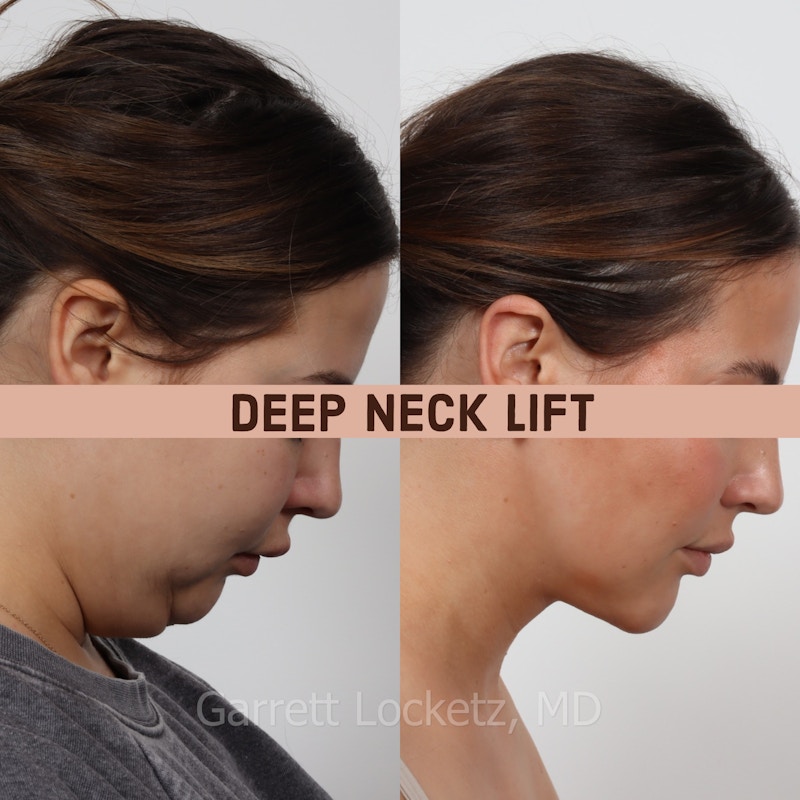 Deep Neck Lift Before & After Gallery - Patient 196509894 - Image 1