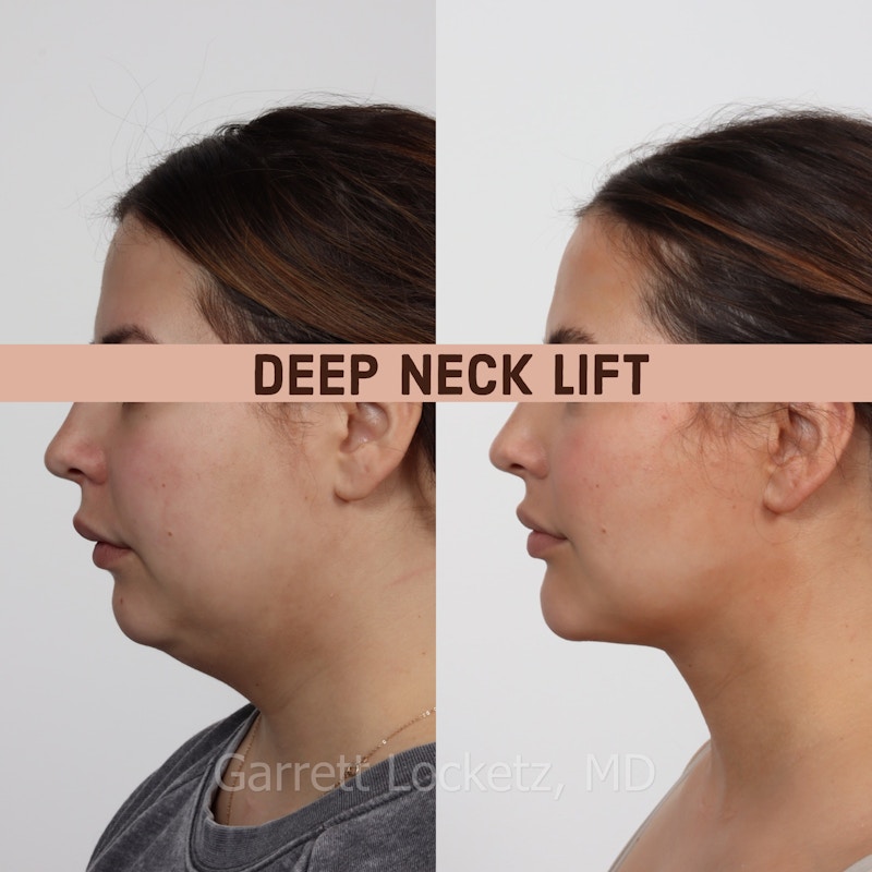 Deep Neck Lift Before & After Gallery - Patient 196509895 - Image 1