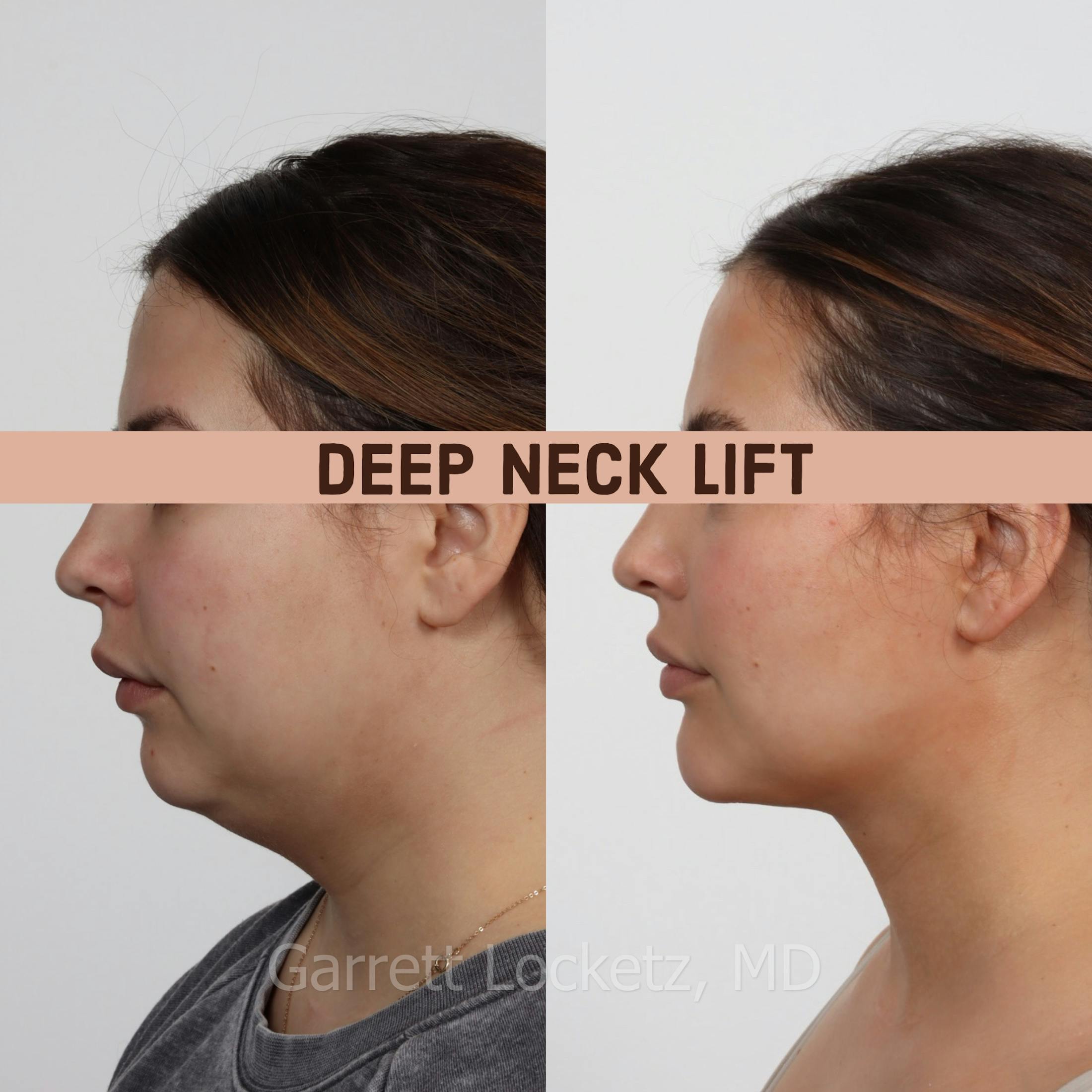 Deep Neck Lift Before & After Gallery - Patient 196509895 - Image 1