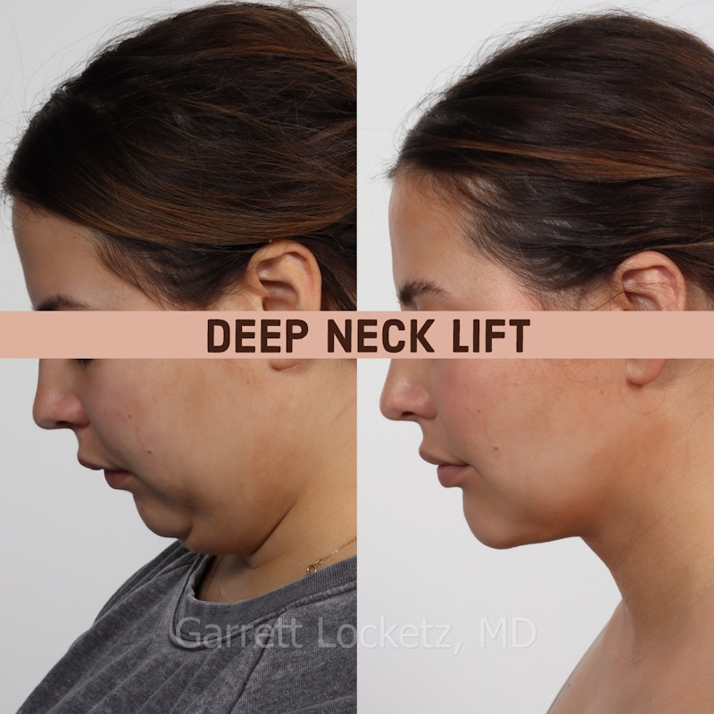 Deep Neck Lift Before & After Gallery - Patient 196509896 - Image 1