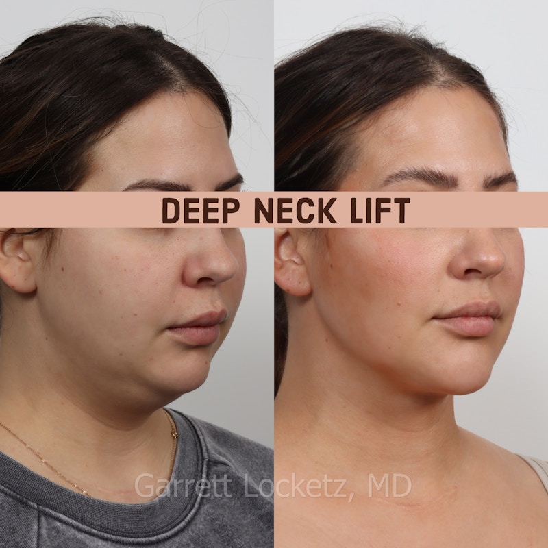 Deep Neck Lift Before & After Gallery - Patient 196509897 - Image 1