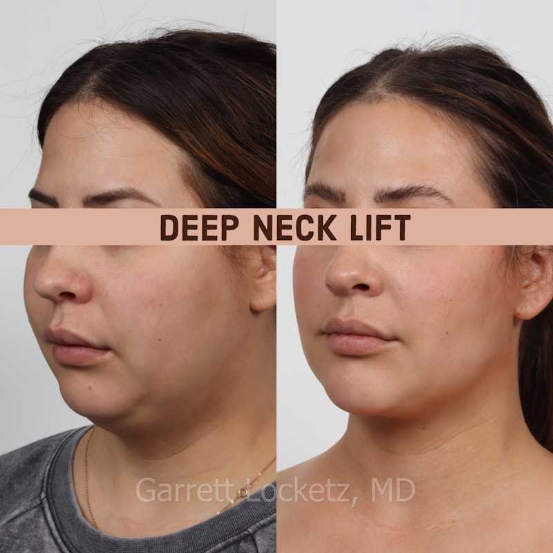 Deep Neck Lift Before & After Gallery - Patient 196509898 - Image 1