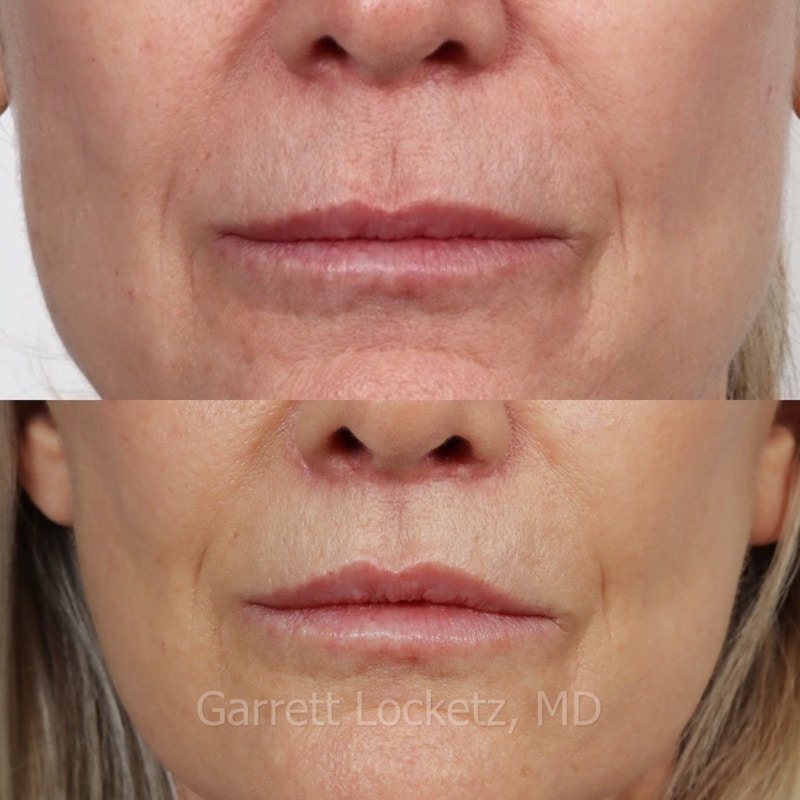 Lip Lift Before & After Gallery - Patient 196509955 - Image 1