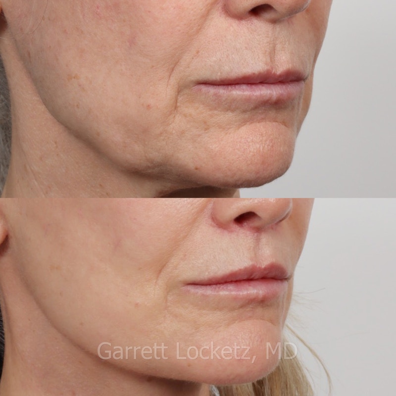 Lip Lift Before & After Gallery - Patient 196509956 - Image 1