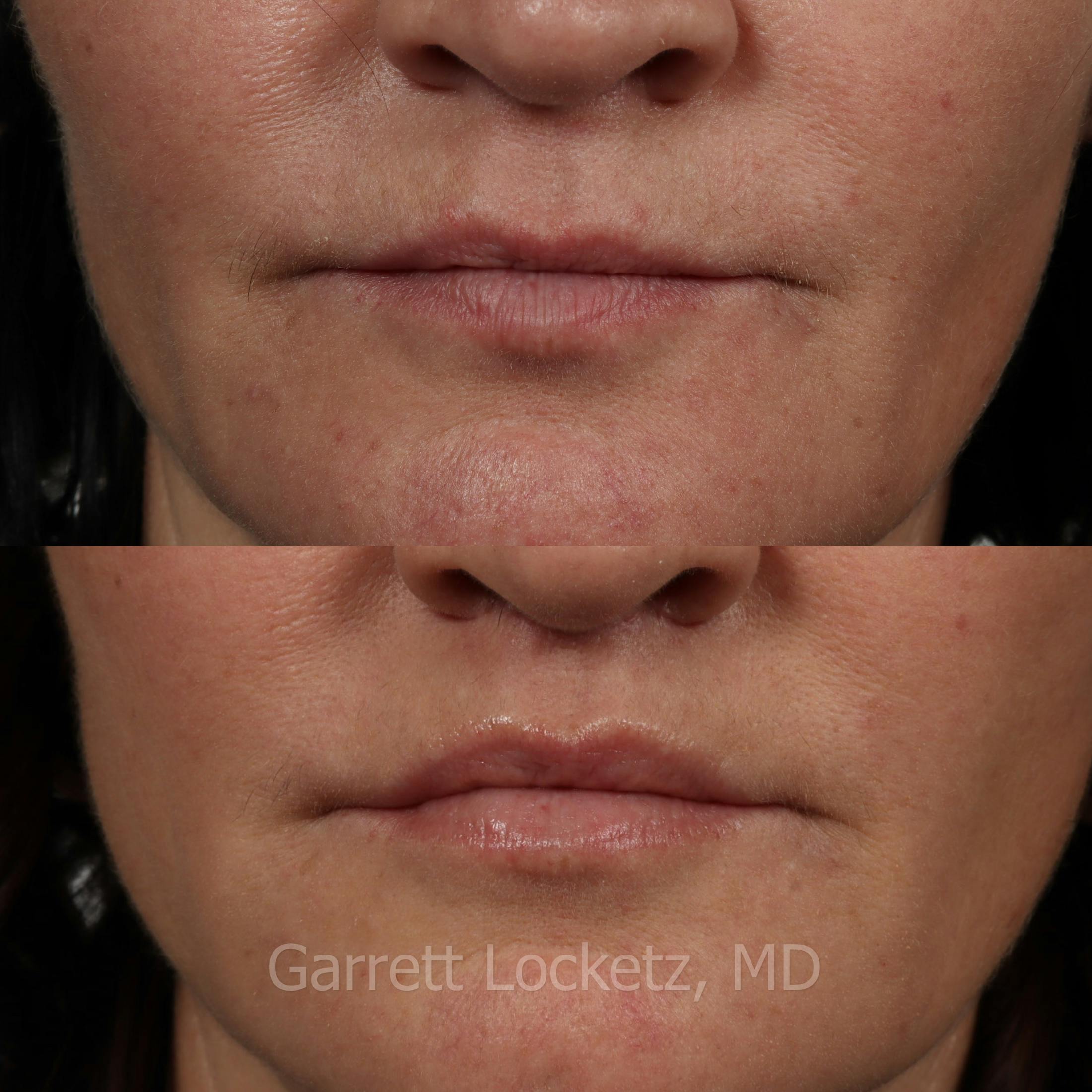 Lip Lift Before & After Gallery - Patient 196509957 - Image 1