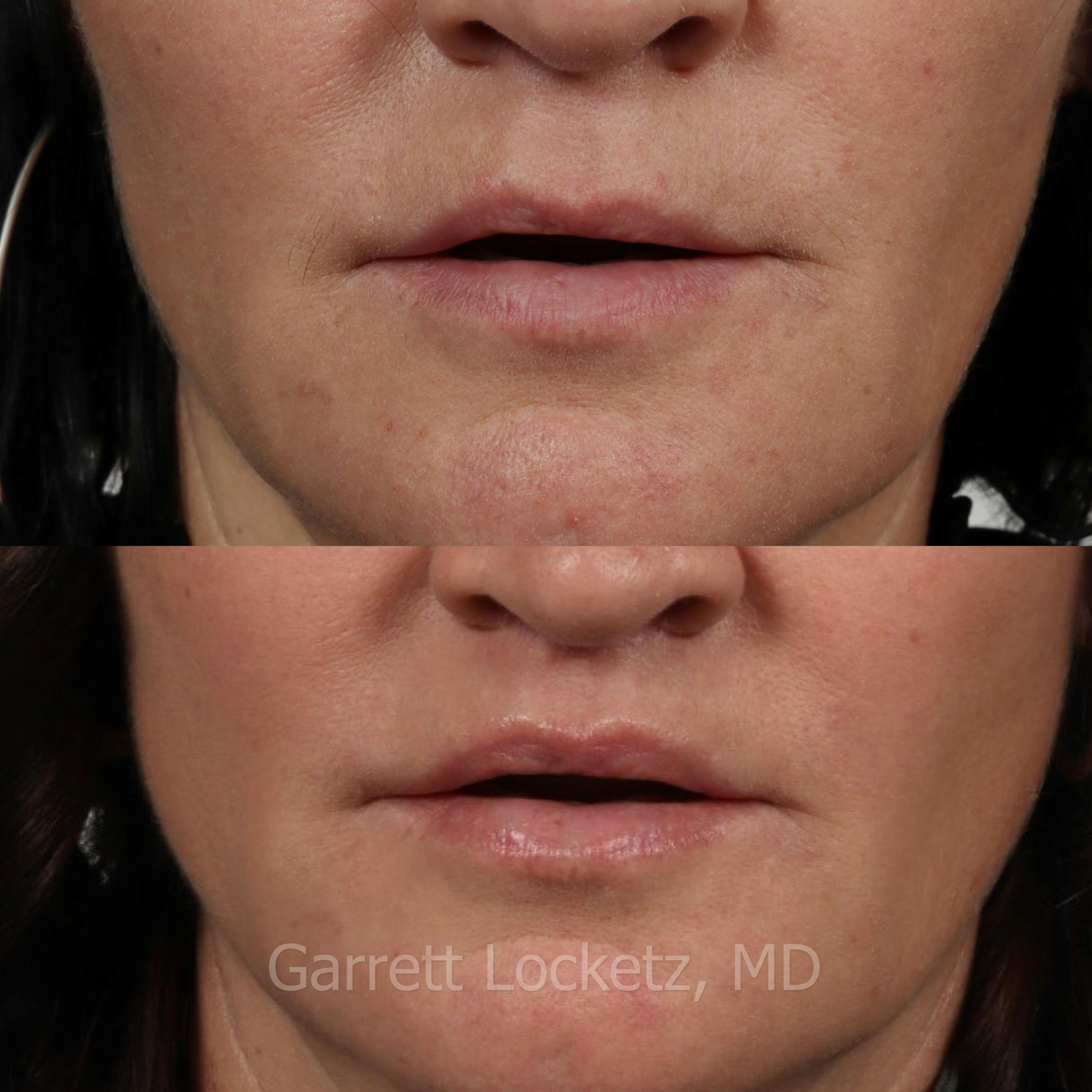 Lip Lift Before & After Gallery - Patient 196509958 - Image 1