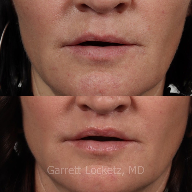 Lip Lift Before & After Gallery - Patient 196509958 - Image 1