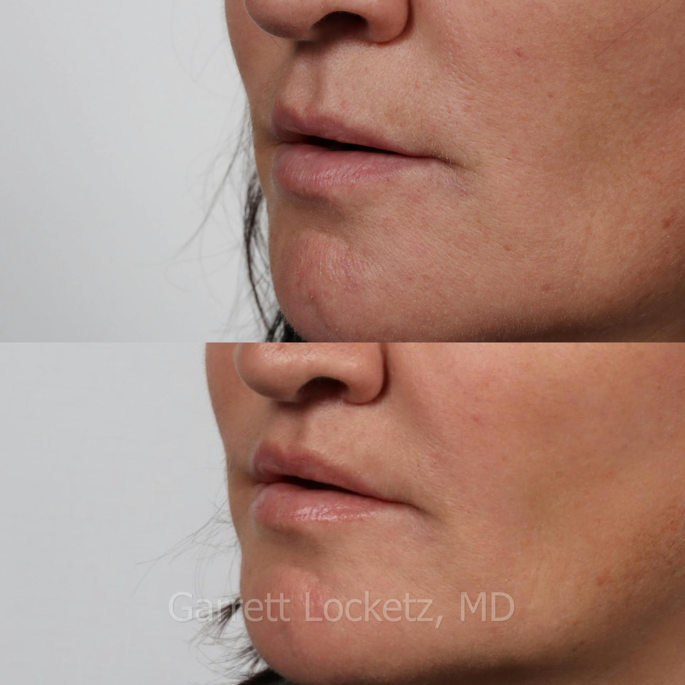 Lip Lift Before & After Gallery - Patient 196509959 - Image 1