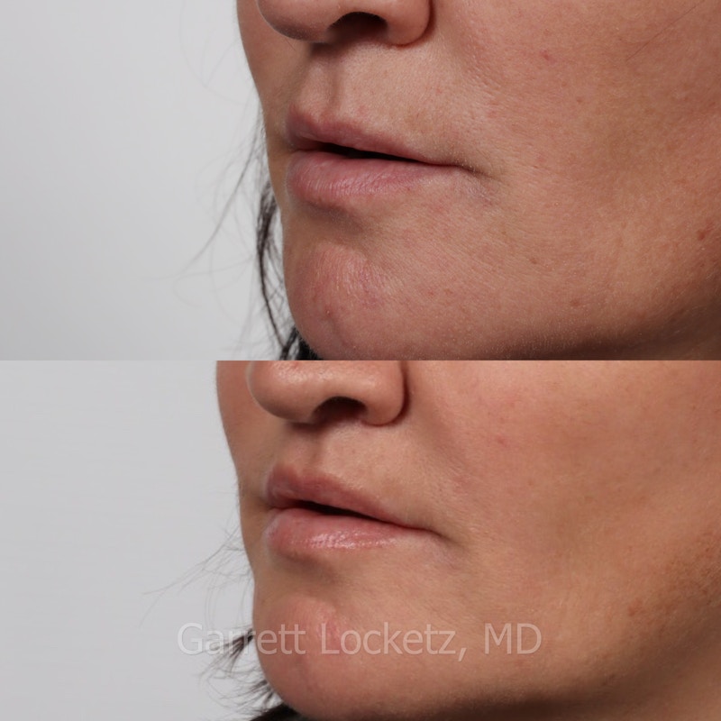 Lip Lift Before & After Gallery - Patient 196509959 - Image 1