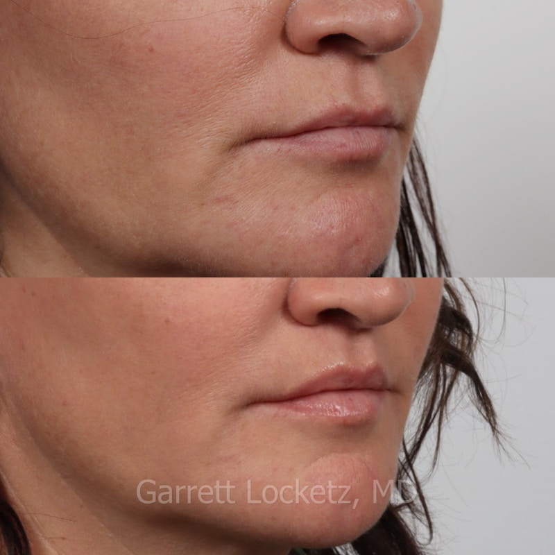 Lip Lift Before & After Gallery - Patient 196509960 - Image 1