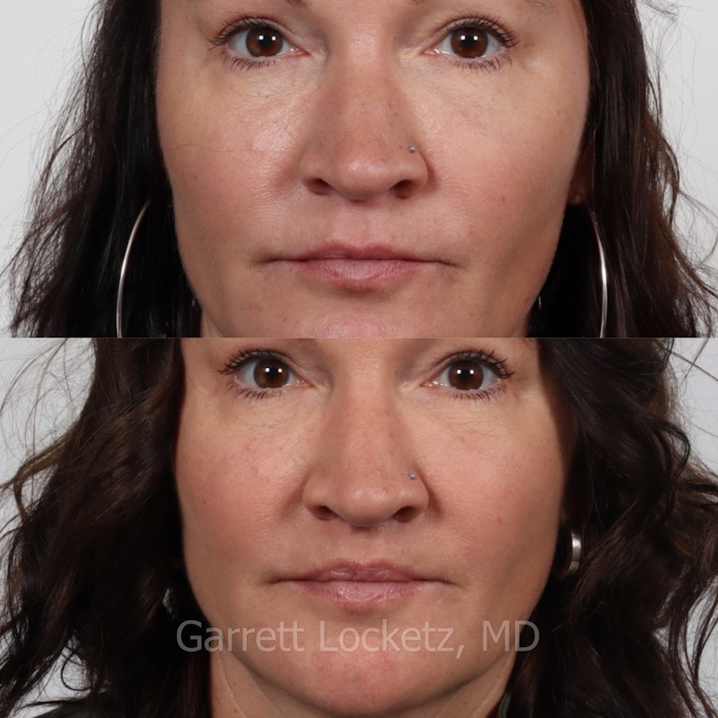 Lip Lift Before & After Gallery - Patient 196509961 - Image 1