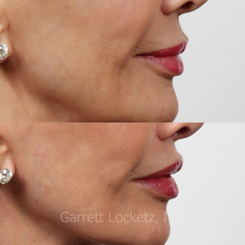 Lip Lift Before & After Gallery - Patient 196509962 - Image 1
