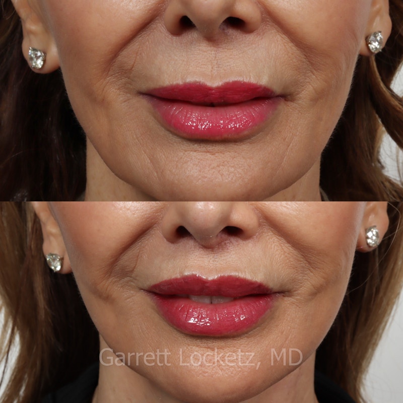Lip Lift Before & After Gallery - Patient 196509963 - Image 1