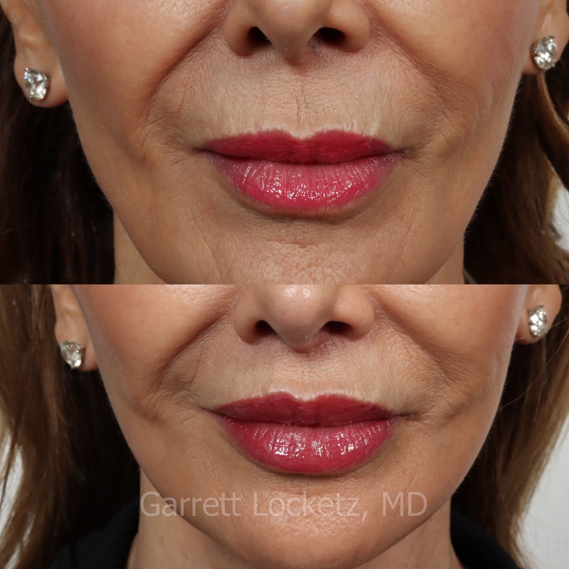 Lip Lift Before & After Gallery - Patient 196509964 - Image 1