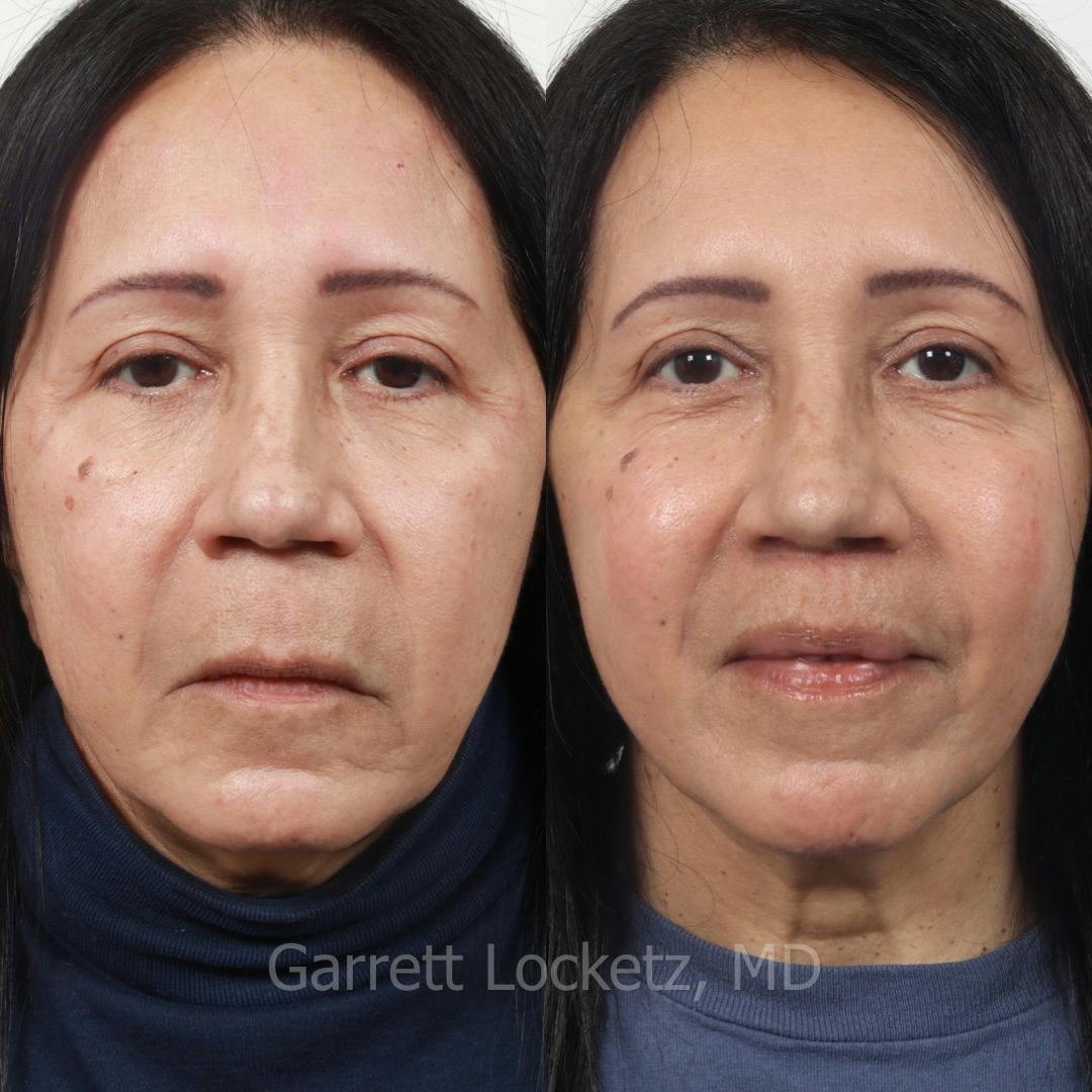 Lip Lift Before & After Gallery - Patient 196509965 - Image 1