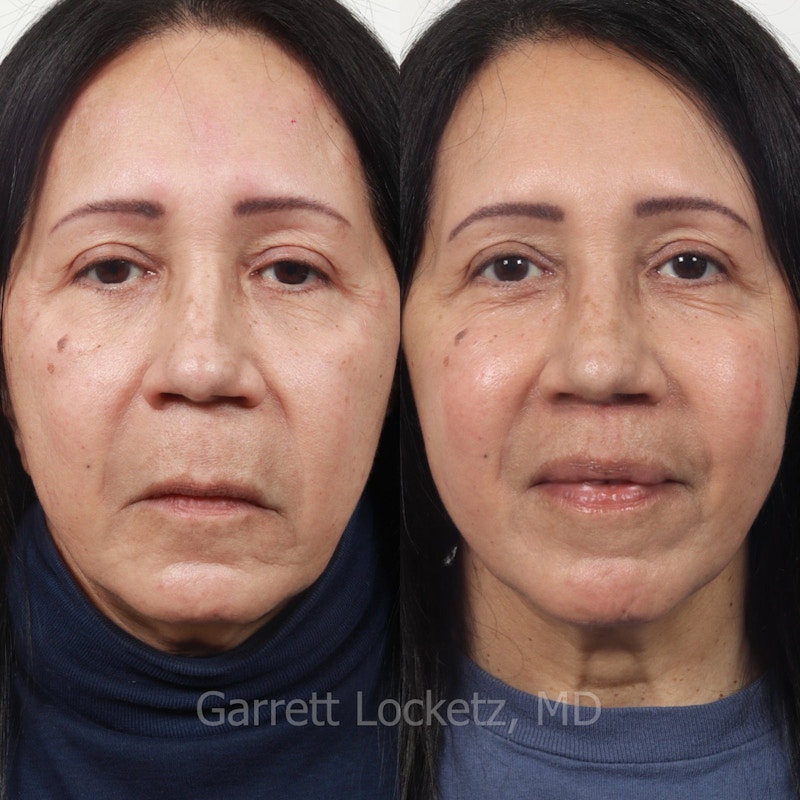 Lip Lift Before & After Gallery - Patient 196509965 - Image 1