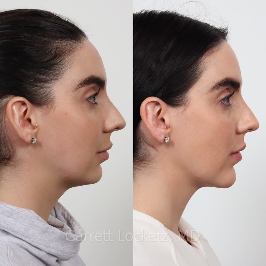 Submental (Chin) Liposuction Before & After Gallery - Patient 196510000 - Image 1