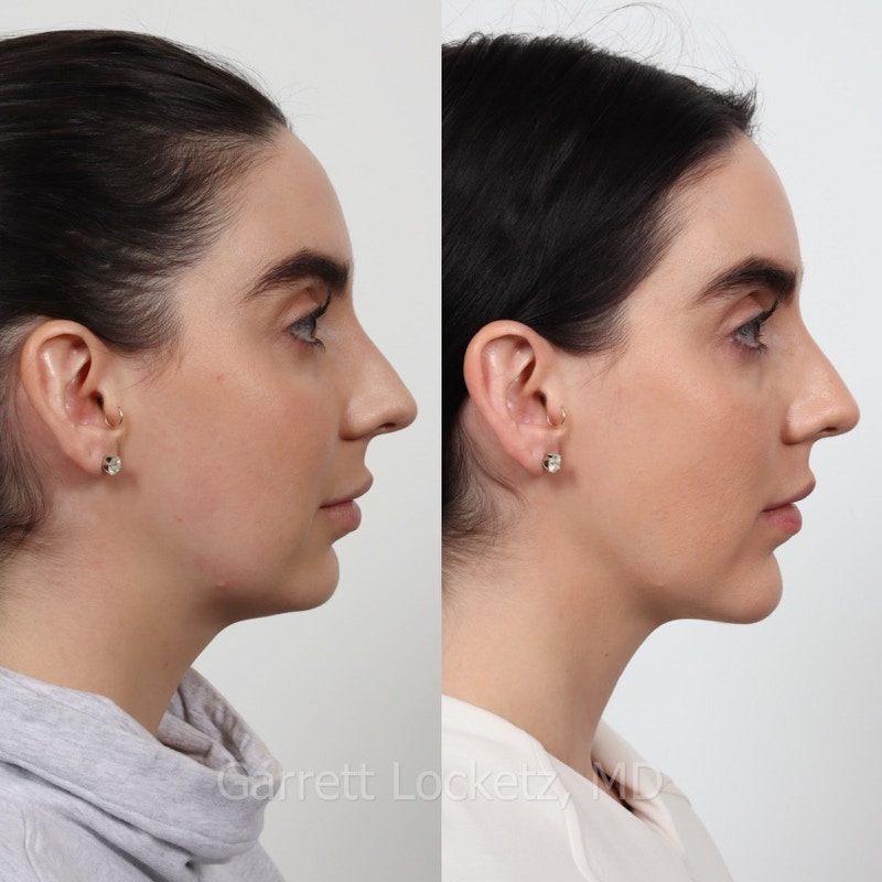 Submental (Chin) Liposuction Before & After Gallery - Patient 196510000 - Image 1