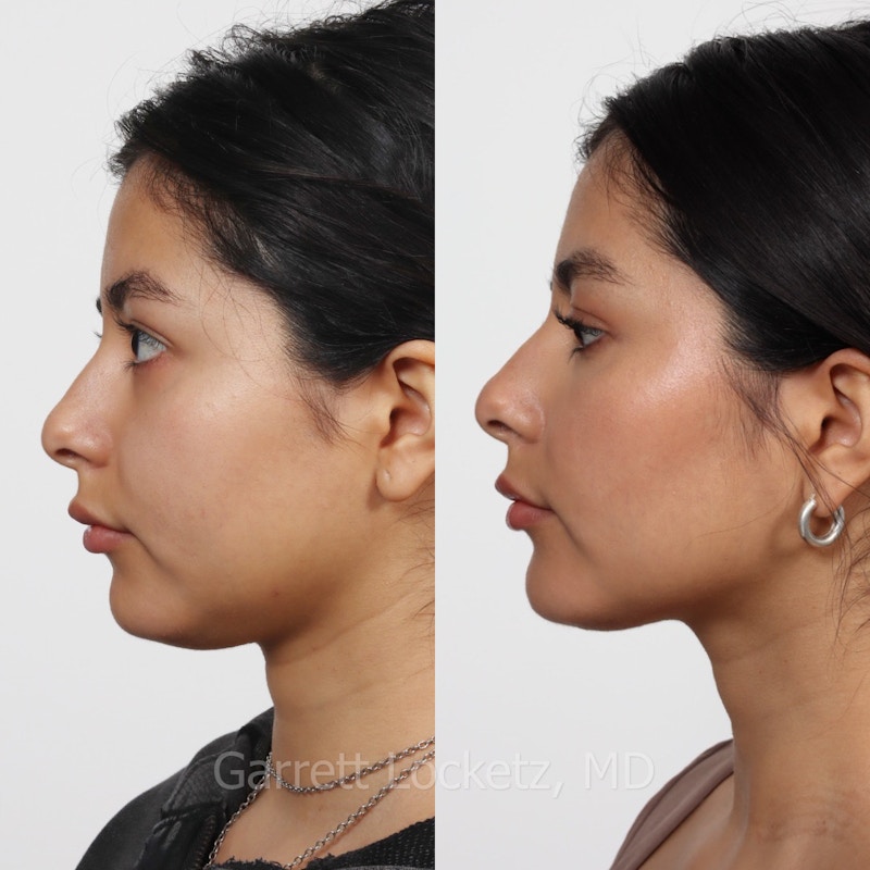 Submental (Chin) Liposuction Before & After Gallery - Patient 196510004 - Image 1