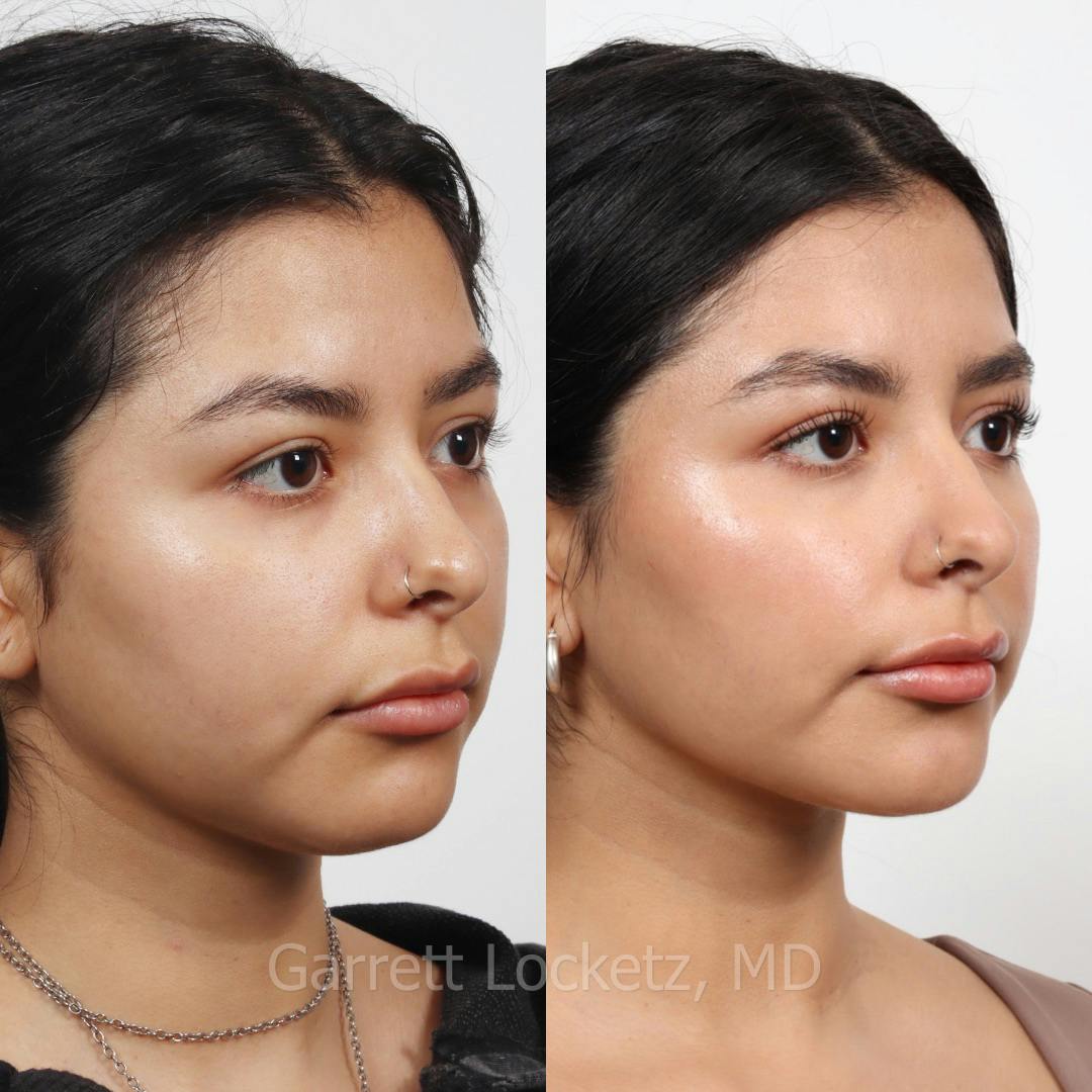Submental (Chin) Liposuction Before & After Gallery - Patient 196510006 - Image 1