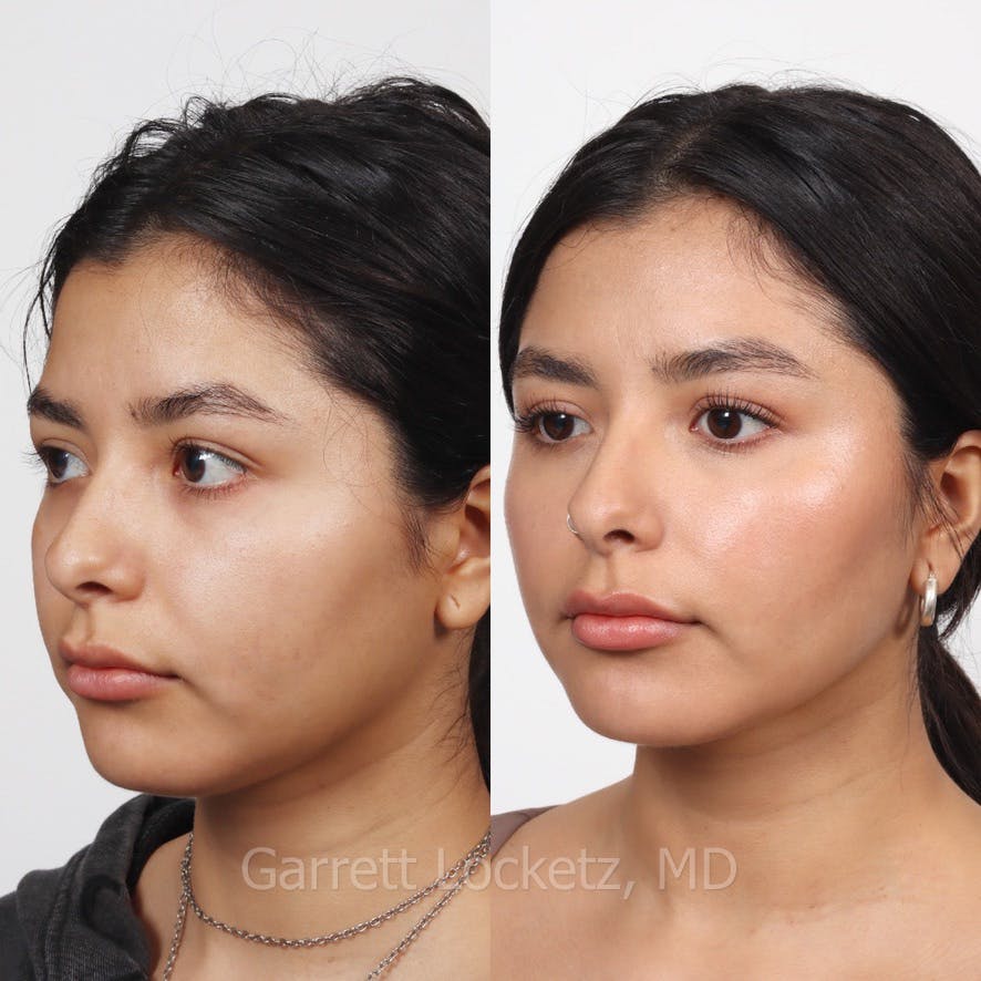 Submental (Chin) Liposuction Before & After Gallery - Patient 196510007 - Image 1