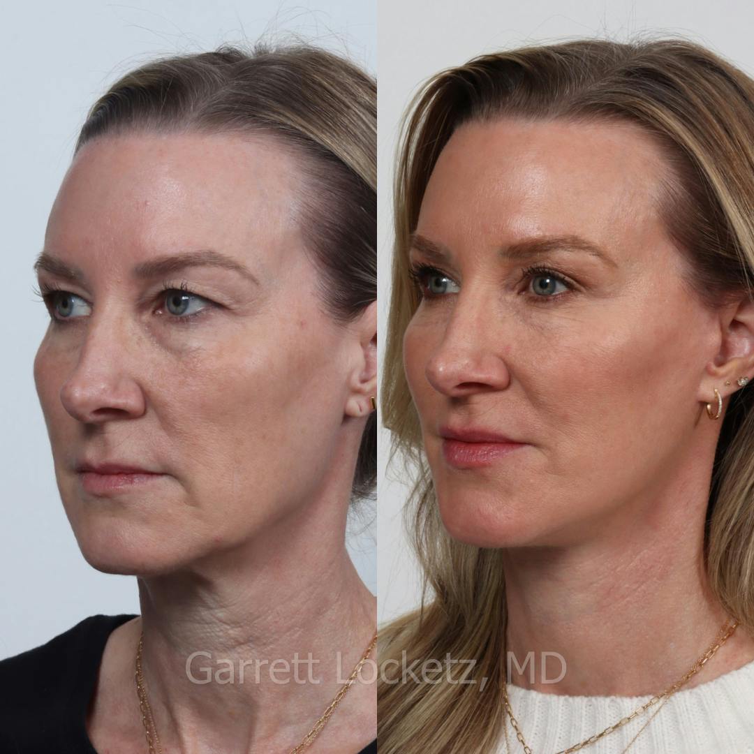 Deep Plane Facelift Before & After Gallery - Patient 197502523 - Image 1