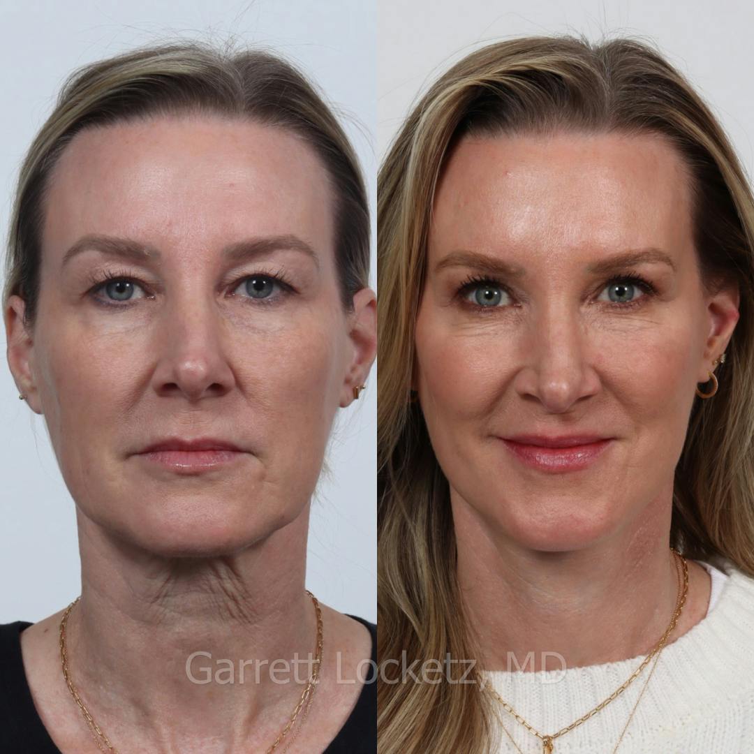Deep Plane Facelift Before & After Gallery - Patient 197502524 - Image 1