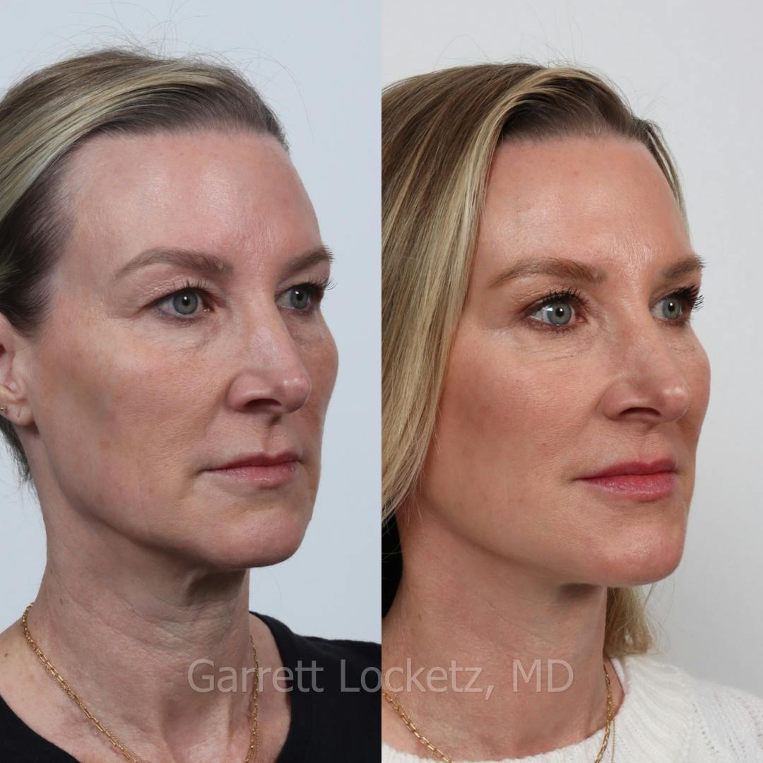 Deep Plane Facelift Before & After Gallery - Patient 197502525 - Image 1