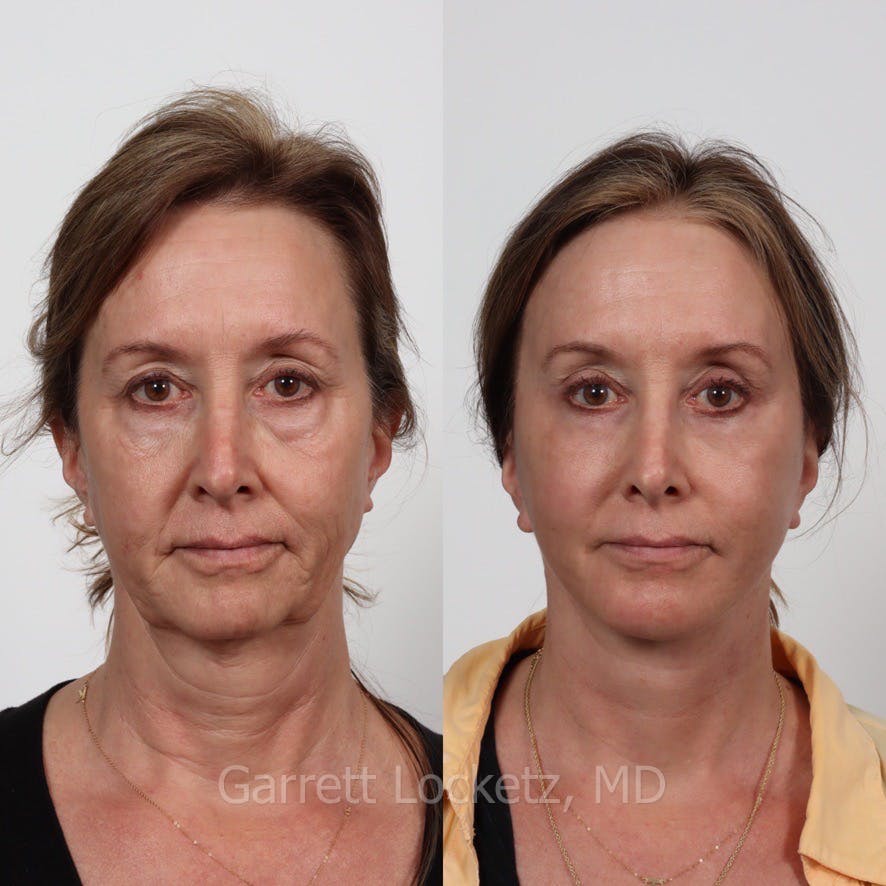 Deep Plane Facelift Before & After Gallery - Patient 197502526 - Image 1