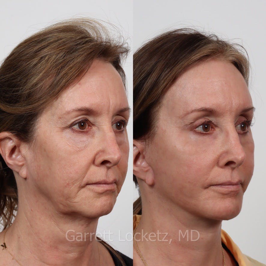Deep Plane Facelift Before & After Gallery - Patient 197502527 - Image 1