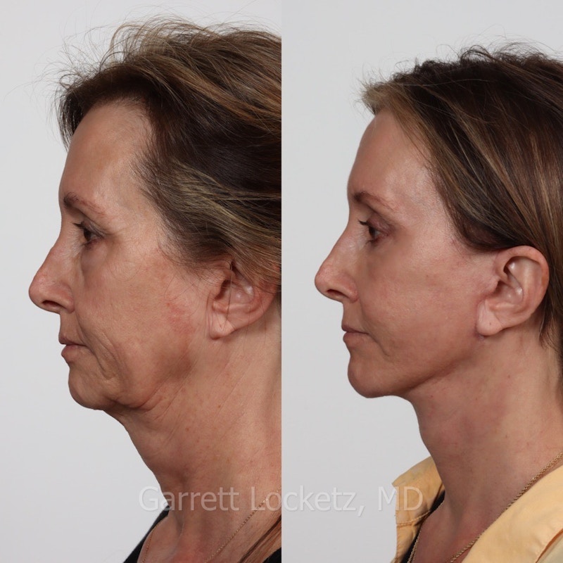 Deep Plane Facelift Before & After Gallery - Patient 197502528 - Image 1