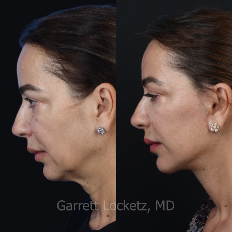 Deep Plane Facelift Before & After Gallery - Patient 197502529 - Image 1