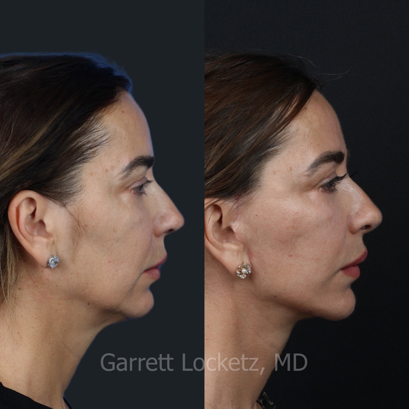 Deep Plane Facelift Before & After Gallery - Patient 197502530 - Image 1