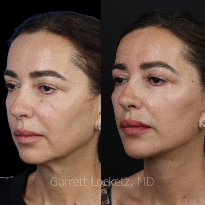 Deep Plane Facelift Before & After Gallery - Patient 197502531 - Image 1