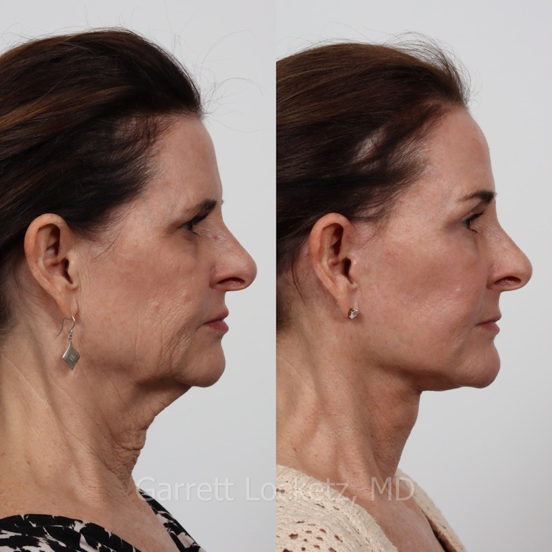 Deep Plane Facelift Before & After Gallery - Patient 197503128 - Image 1