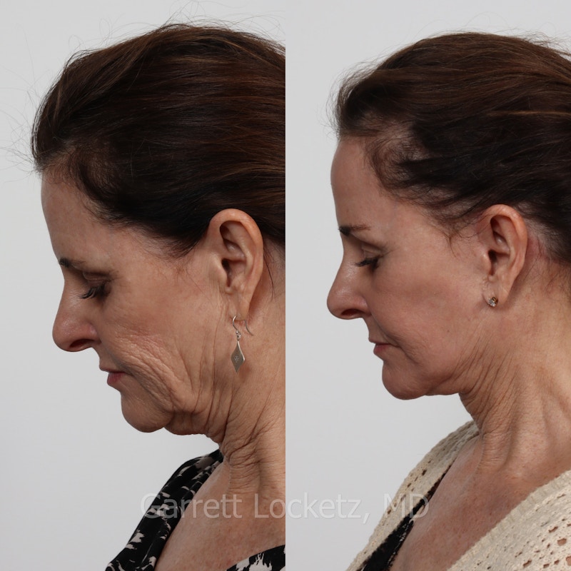 Deep Plane Facelift Before & After Gallery - Patient 197503129 - Image 1