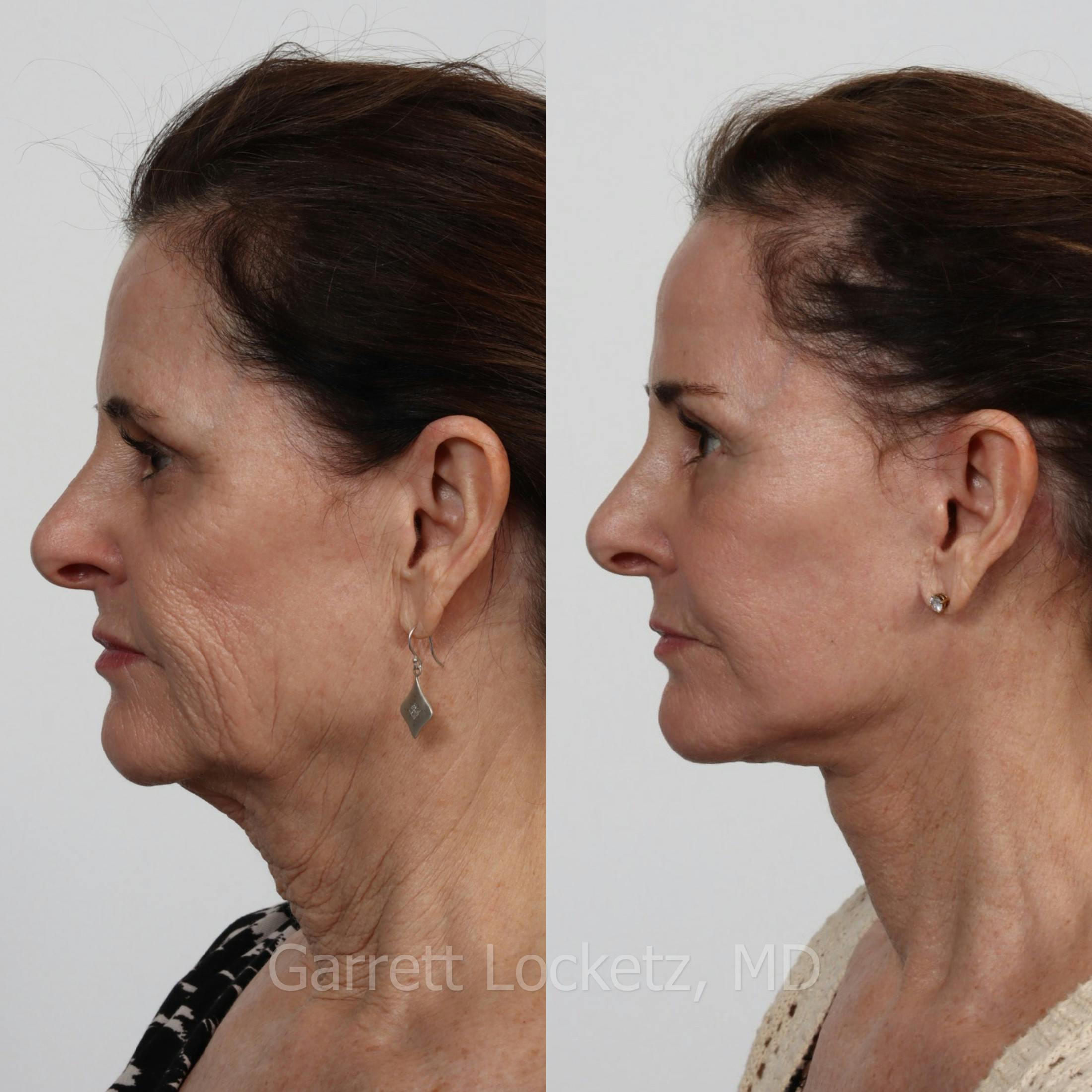 Deep Plane Facelift Before & After Gallery - Patient 197503130 - Image 1