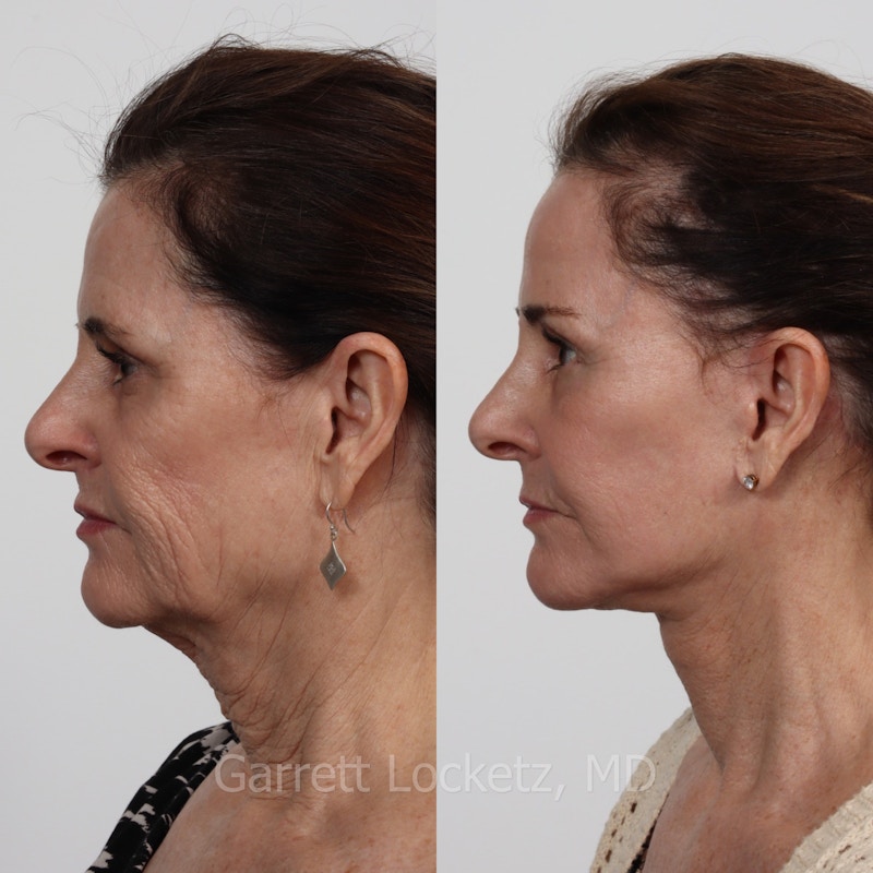 Deep Plane Facelift Before & After Gallery - Patient 197503130 - Image 1