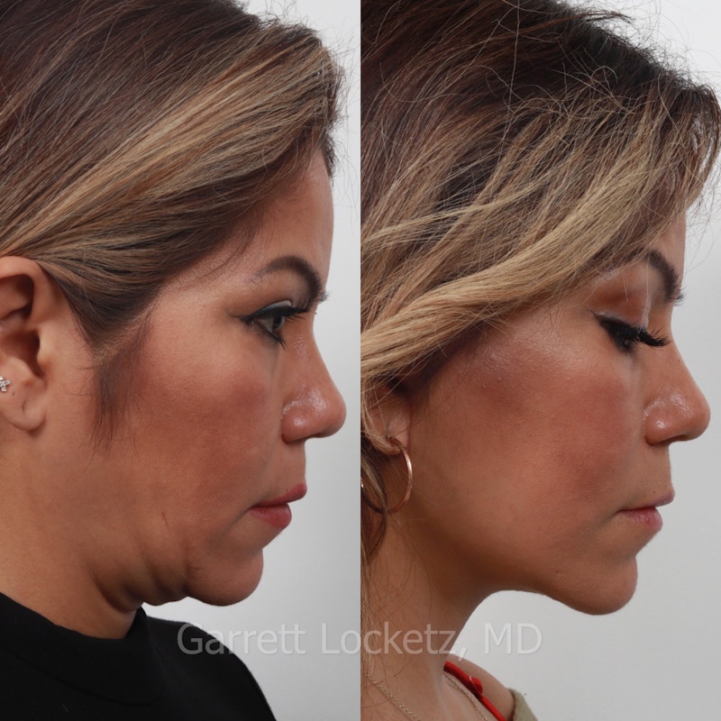 Deep Plane Facelift Before & After Gallery - Patient 197503131 - Image 1