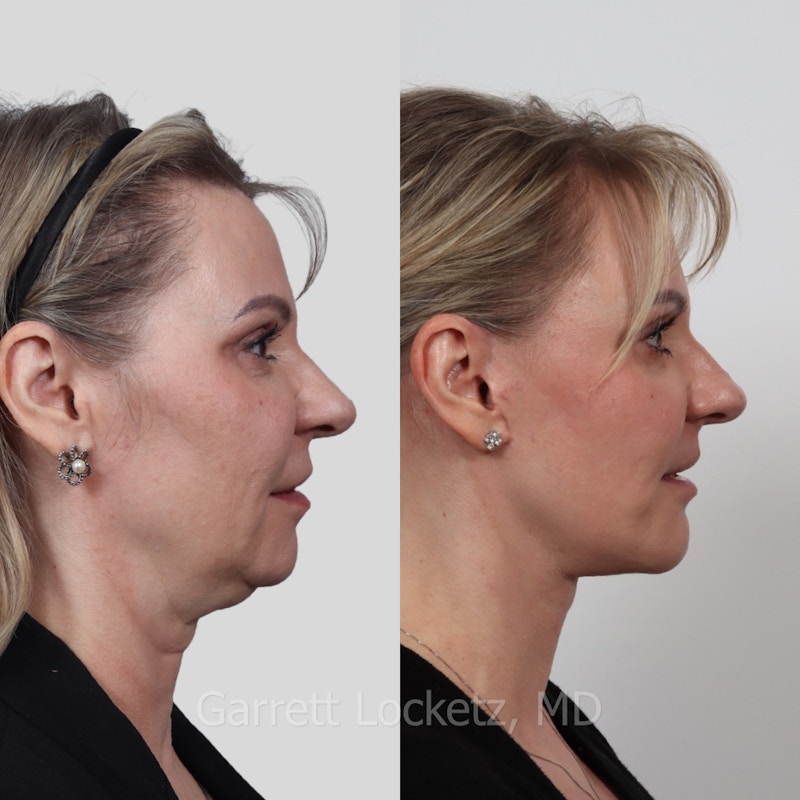 Deep Plane Facelift Before & After Gallery - Patient 197503134 - Image 1