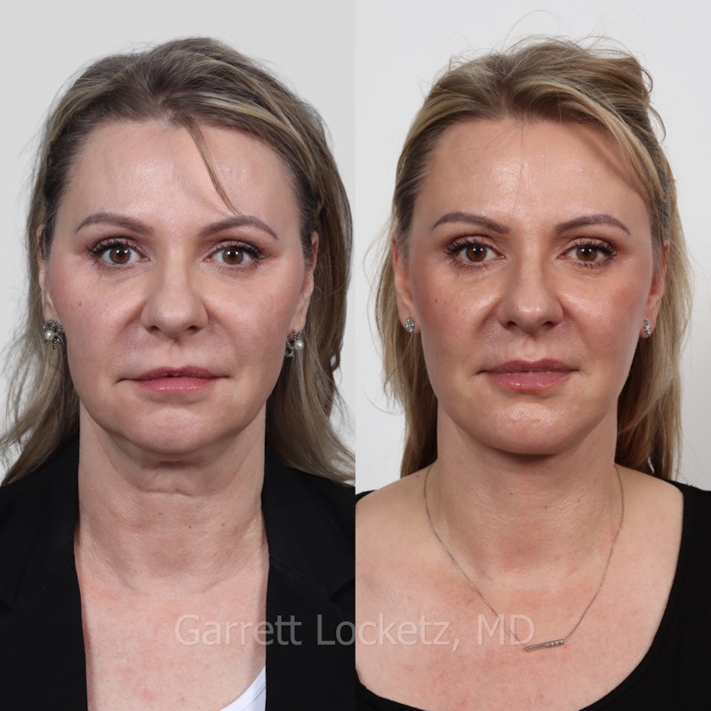 Deep Plane Facelift Before & After Gallery - Patient 197503135 - Image 1