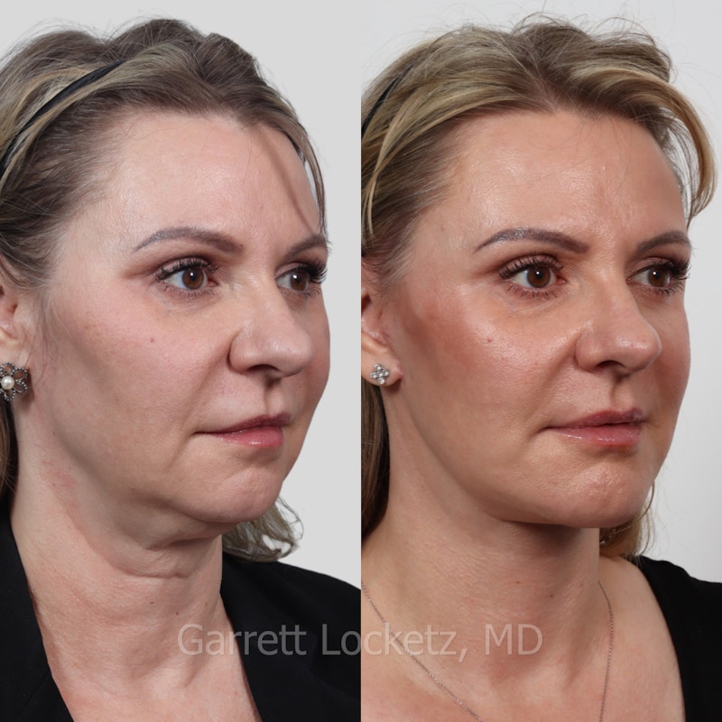 Deep Plane Facelift Before & After Gallery - Patient 197503136 - Image 1