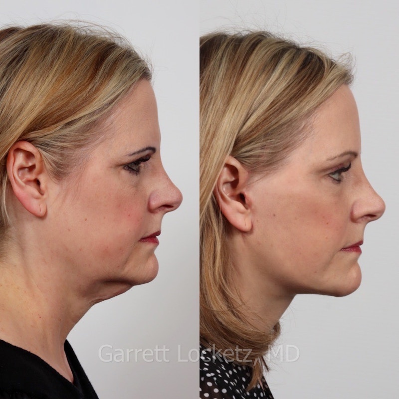 Deep Plane Facelift Before & After Gallery - Patient 197503137 - Image 1