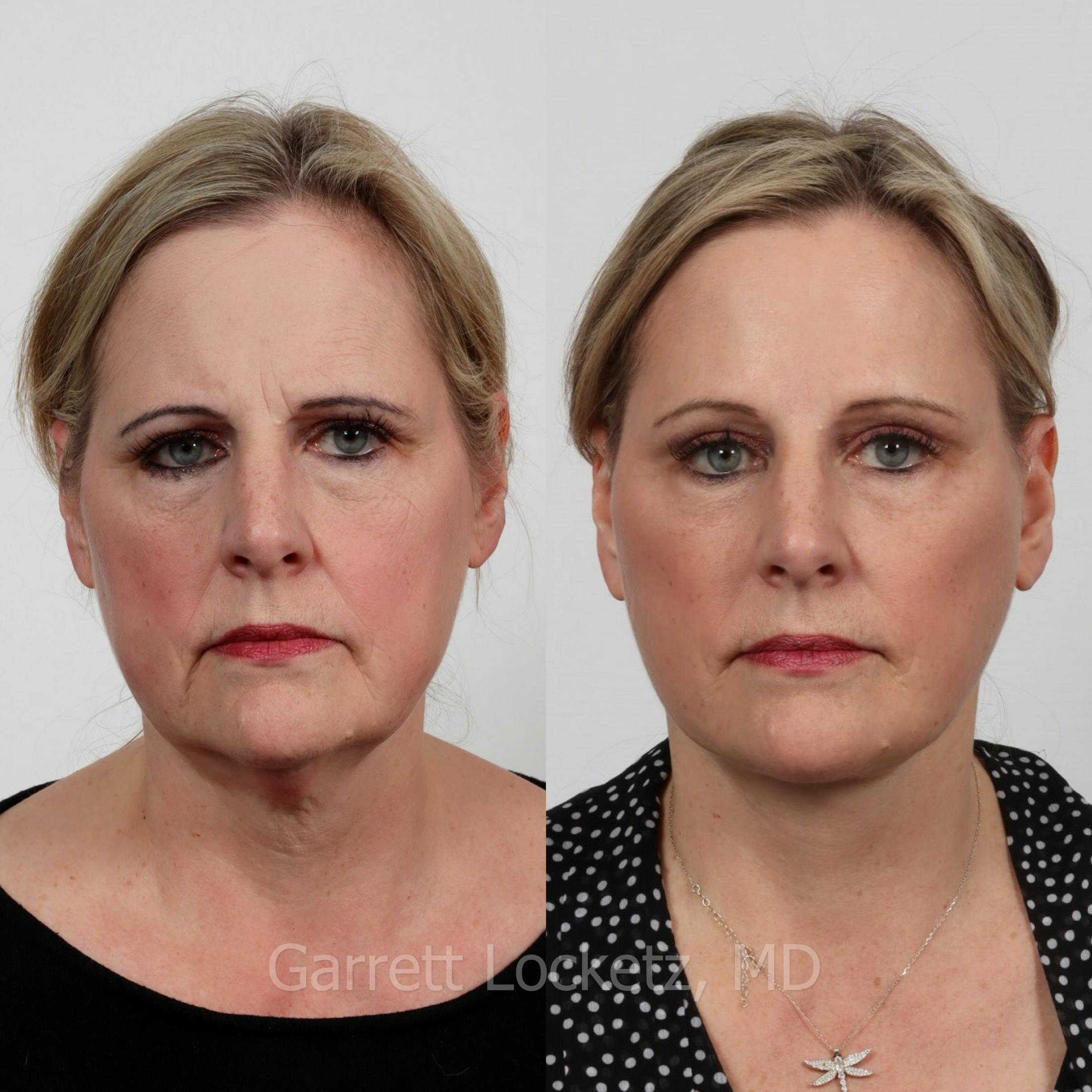 Deep Plane Facelift Before & After Gallery - Patient 197503138 - Image 1