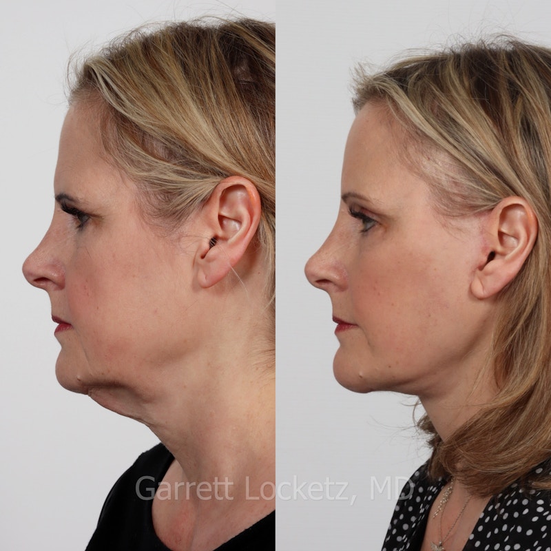 Deep Plane Facelift Before & After Gallery - Patient 197503139 - Image 1